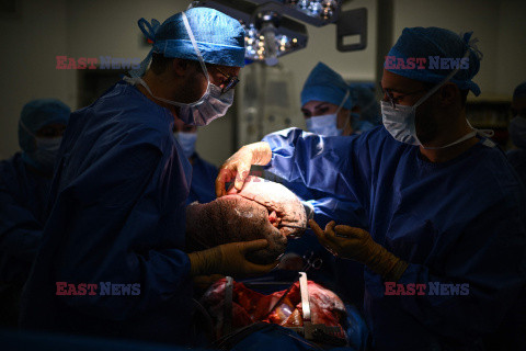 Transplantologia we Francji - AFP